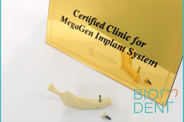 Clinica Dentale Biodent, clinica certificata per gli impianti dentali Megagen in Albania