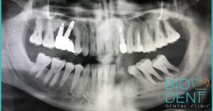 Radiografia panoramica con fallimento degli impianti dentali low cost