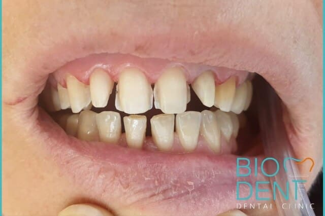 Rivitalizza Il Tuo Sorriso Con Le Faccette Dentali - Clinica Dentale Biodent