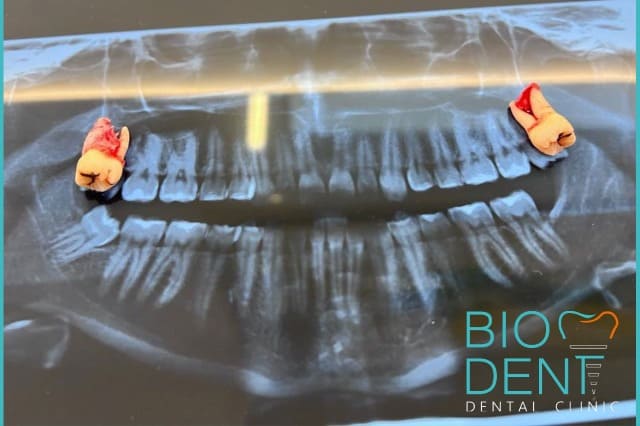 Panoramica dentale per vedere due denti estratti