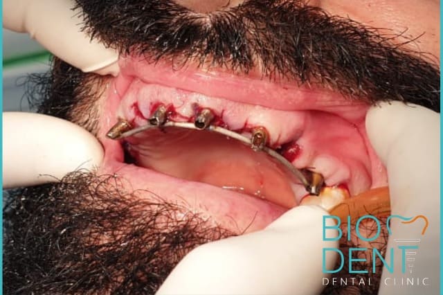 Impianti dentali in un paziente che ha sofferto di parodontite