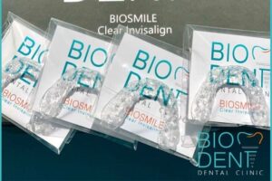 Apparecchio trasparente della Clinica Dentale Biodent