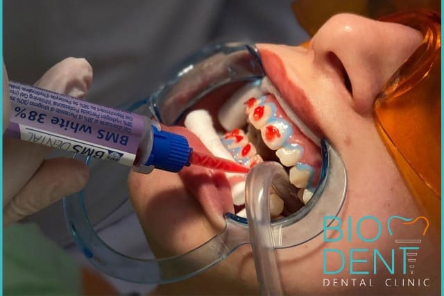 Applicazione del gel per lo sbiancamento dentale che ha scelto i servizi dei dentisti in Albania della Clinica Dentale Biodent
