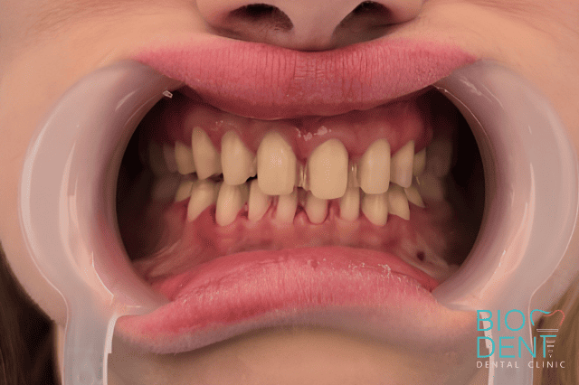 Limatura dei denti per preparare le faccette dentali