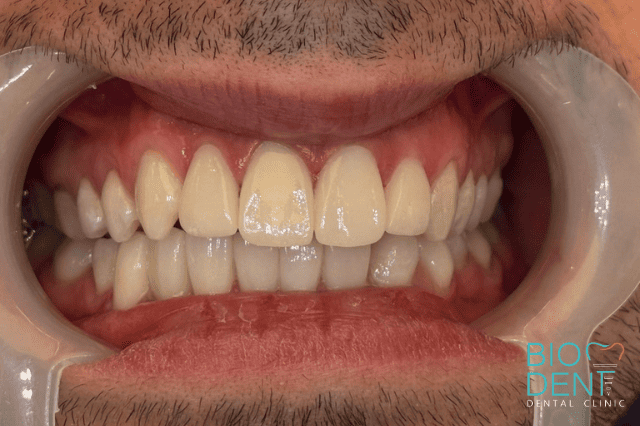 Denti con faccette dentali su uomo fatti a Tirana in Albania con il turismo dentale Biodent