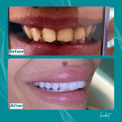 Risultati faccette dentali prima e dopo alla Clinica Dentale Biodent, turismo dentale in Albania