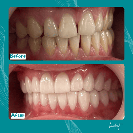 Esempio di faccette dentali prima e dopo alla Clinica Dentale Biodent, turismo dentale in Albania