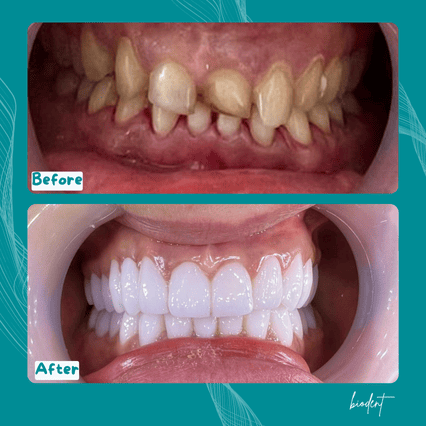 Sorriso trasformato con faccette dentali prima e dopo presso la Clinica Dentale Biodent
