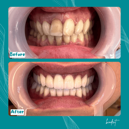 Faccette dentali prima e dopo realizzate dai migliori dentisti in Albania, Clinica Dentale Biodent