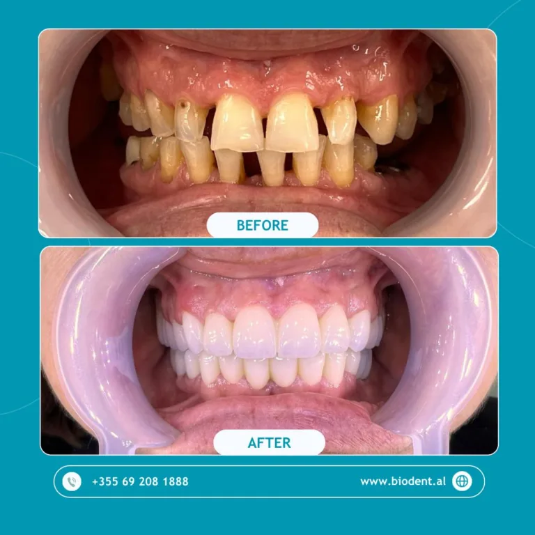 Impianti_Dentali_Albania_Prima_e_Dopo_01