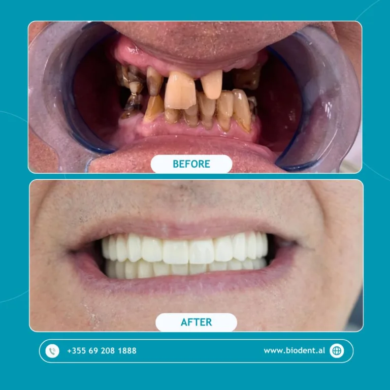Impianti_Dentali_Albania_Prima_e_Dopo_02