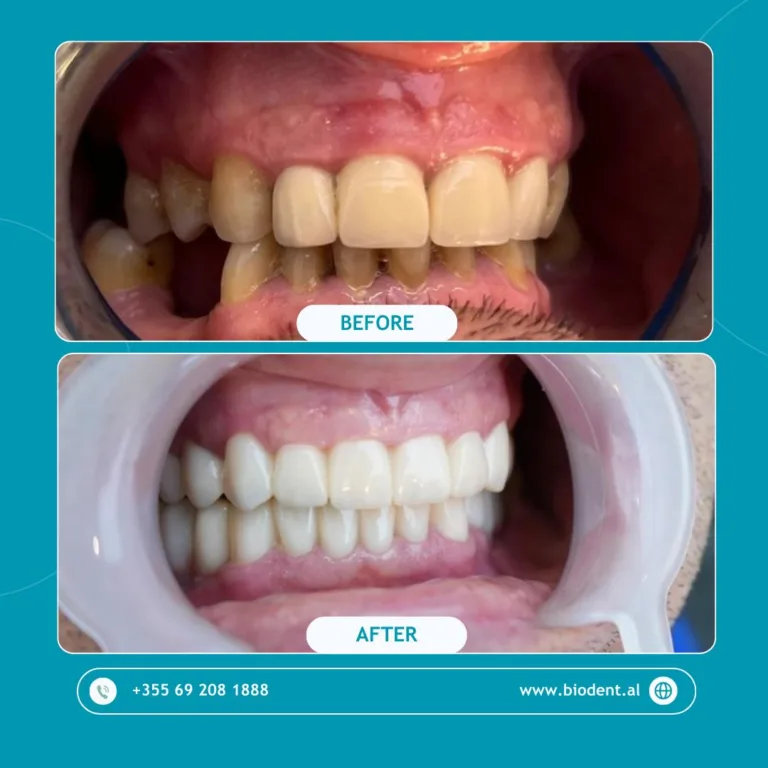 Impianti_Dentali_Albania_Prima_e_Dopo_03