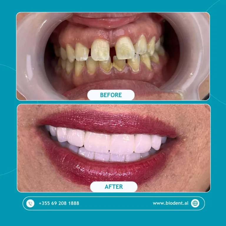 Impianti_Dentali_Albania_Prima_e_Dopo_05