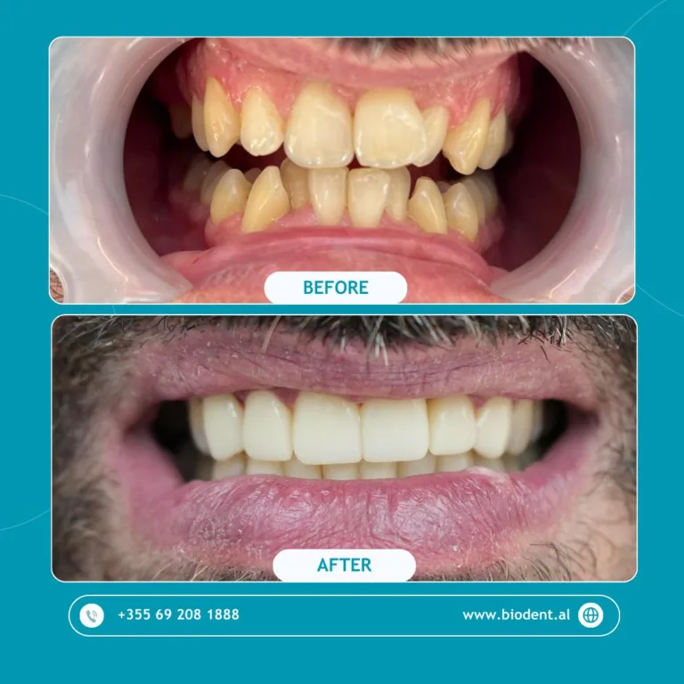 Impianti_Dentali_Albania_Prima_e_Dopo_06