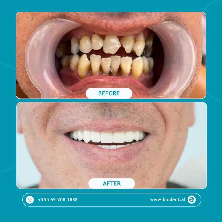 Impianti_Dentali_Albania_Prima_e_Dopo_07