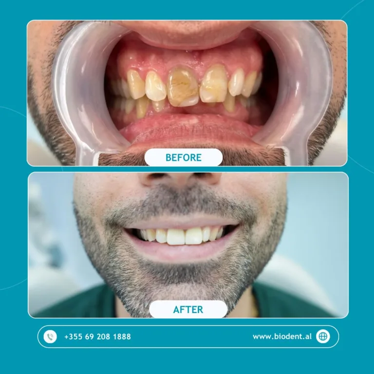 Impianti_Dentali_Albania_Prima_e_Dopo_08