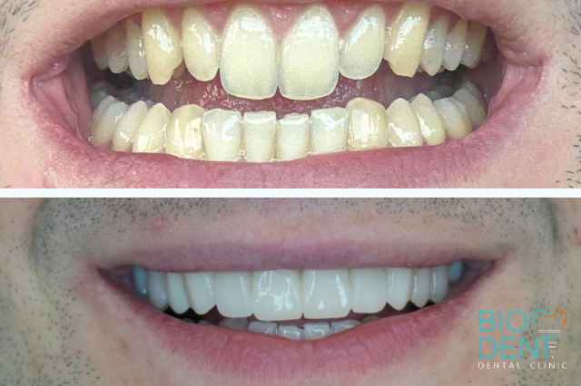 Foto di faccette con i denti, prima e dopo fatti da i dentisti in Albania a Tirana