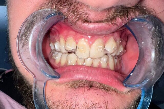 Adulti con apparecchio trasparente alla Clinica Dentale Biodent a Tirana, turismo dentale