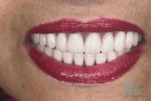 Protesi all on four per riabilitazione completa dell’arcata dentale con turismo dentale da Biodent