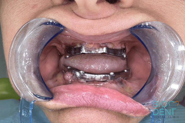 Protesi all on four con barra applicata su paziente presso la clinica Biodent