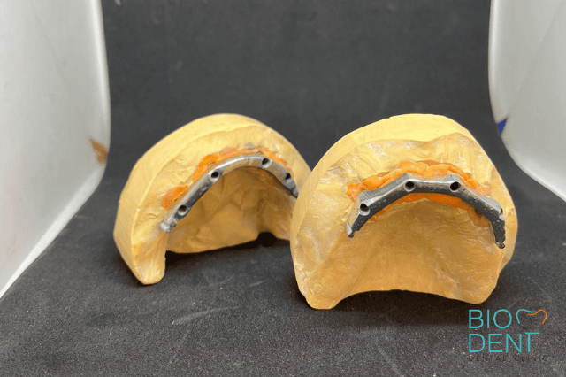 Protesi all on four con barra implantare per maggiore stabilità funzionale dai dentisti in Albania Biodent