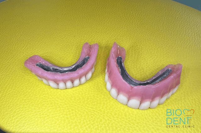 Protesi all on four con controbarra per gestione dell’igiene dai dentisti in Albania Biodent