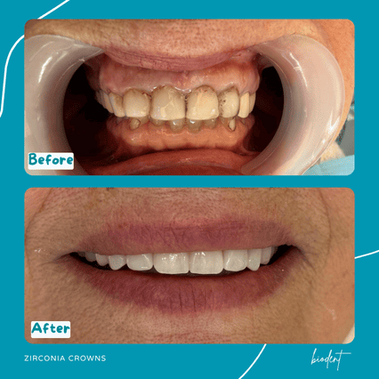 Prima e dopo corone in zirconia di Adelina, cure dentali clinica dentale Biodent a Tirana