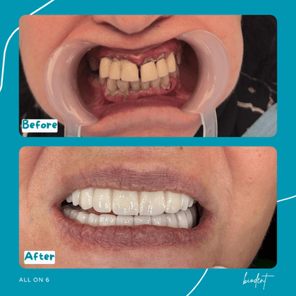 Prima e dopo All-on-6 di Alessandra, turismo dentale clinica dentale Biodent in Albania
