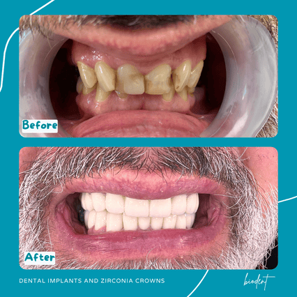 Prima e dopo impianti dentali e corone zirconia di Dennis, clinica dentale Biodent a Tirana