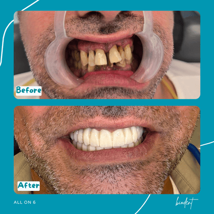 Prima e dopo All-on-6 di Ervis con parodontosi avanzata, clinica dentale Biodent in Albania