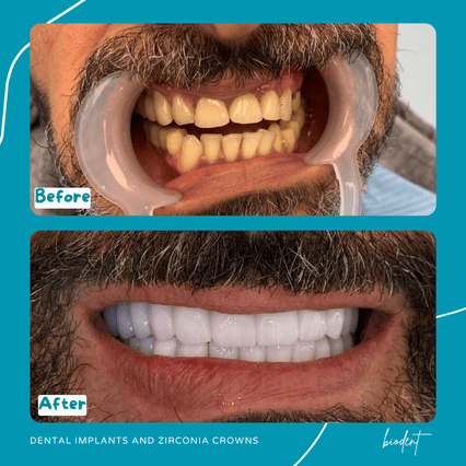 Prima e dopo impianti e corone zirconia di Gino, cure dentali clinica dentale Biodent