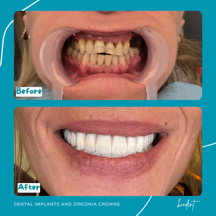 Prima e dopo impianti e corone zirconia di Giuseppina, turismo dentale clinica dentale Biodent