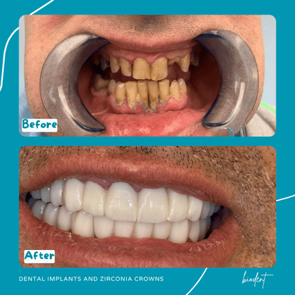 Prima e dopo impianti e corone zirconia di Marco, dentisti a Tirana clinica dentale Biodent