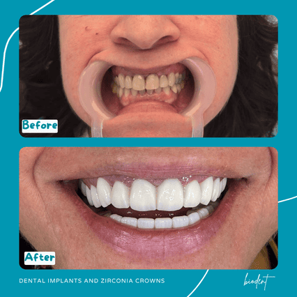 Prima e dopo impianti e corone zirconia di Roberta, cure dentali clinica dentale Biodent