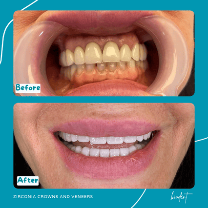 Prima e dopo corone zirconia e faccette dentali di Suzana, turismo dentale clinica dentale Biodent