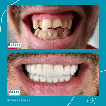 Before and after zirconia crowns by Munforte, dentists in Albania at Biodent dental clinic