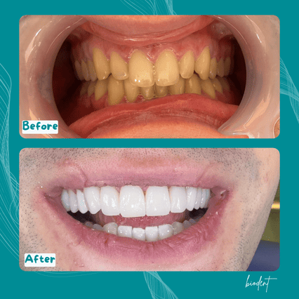 dental veneers before and after with dentists in albania biodent
