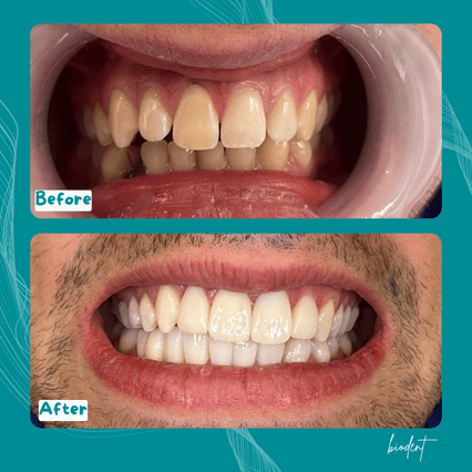 dental veneers before and after with dental tourism in albania