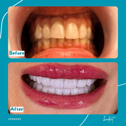 Before and After Photos of Emax Dental Veneers at the Biodent Clinic in Tirana, Albania
