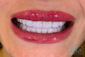 Risultato faccette dentali in emax nella clinica Biodent a Tirana in Albania