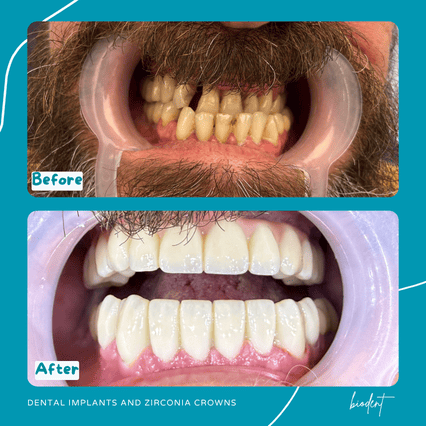 Prima e dopo impianti dentali e corone in zirconia per [Nome], Biodent clinica dentale a Tirana