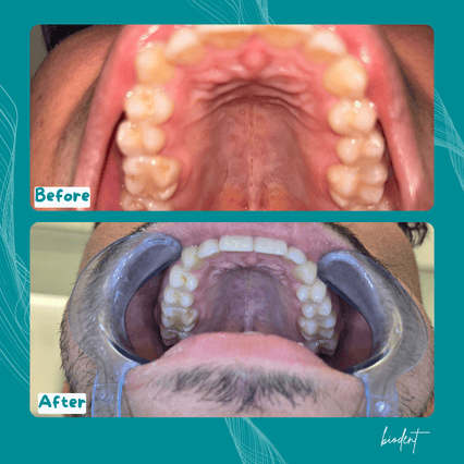 Prima e dopo apparecchio trasparente, cure dentali clinica dentale Biodent a Tirana