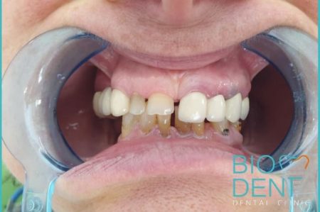 Le cure dentali con protesi mobile scheletrata di Dylbere