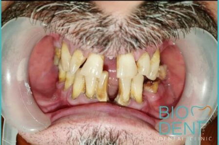 Le cure dentali a Tirana in Albania alla parodontite ereditaria di Luigi