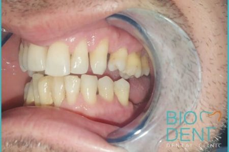 Devitalizzazione dei denti e corone in zirconio per Marco