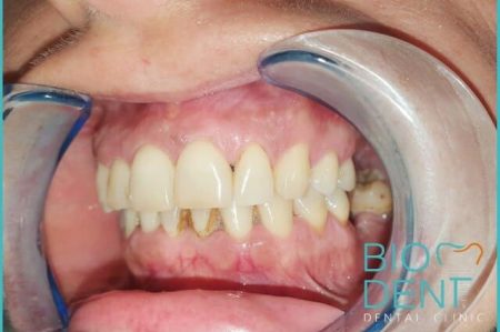 Devitalizzazione dei denti e corone in zirconio per Paola