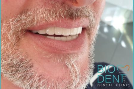 La cura della parodontite con il turismo dentale di Pasquale