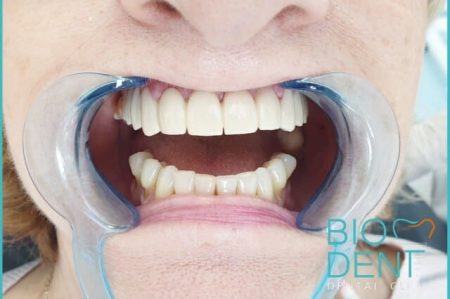 Pasqualina con il turismo dentale ha ottenuto la terapia conservativa dei denti