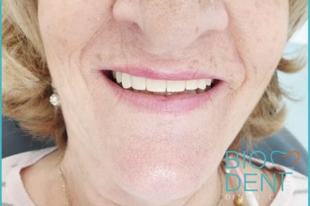 Pasqualina con il turismo dentale ha ottenuto la terapia conservativa dei denti
